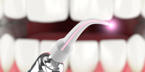 laser used to treat gums. The concept of using laser therapy in the treatment of gums